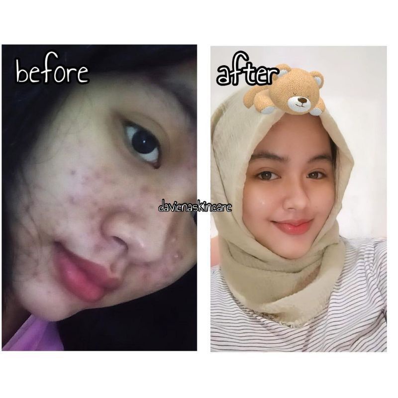 Daviena Skincare Paket Acne Series Davienaskincareofficial Davina Devina Lampung Surabaya Jakarta Jerawat Pencerah Pemutih Wajah Glowing Bpom Daviena Skincare-5