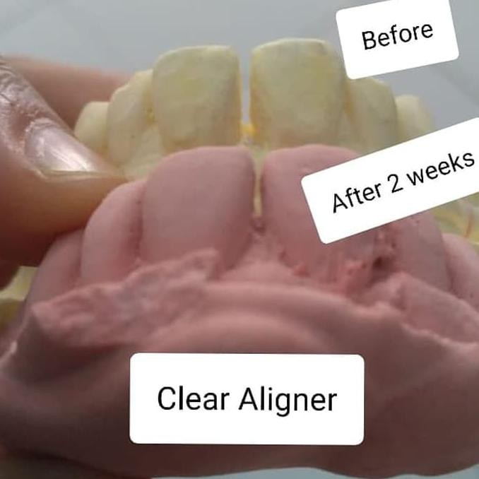 Clear Aligner / Invisalign / Perapi Gigi / Behel Transparan