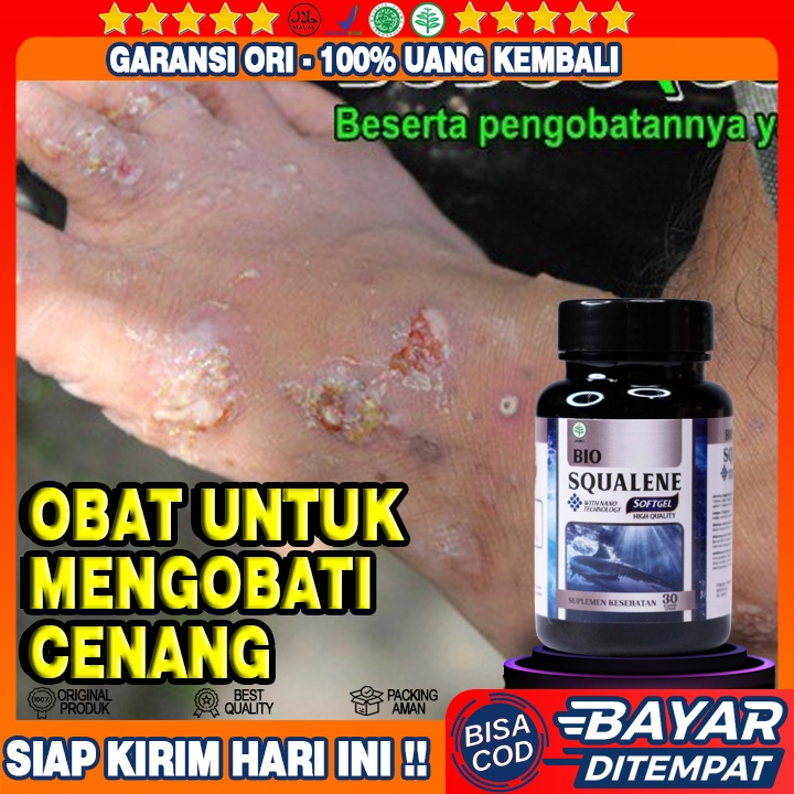 Obat Cenang - Cenang Bernanah - Gatal Cenang Bernanah - Cenang Di Telapak Tangan Kaki - Cenang Berai