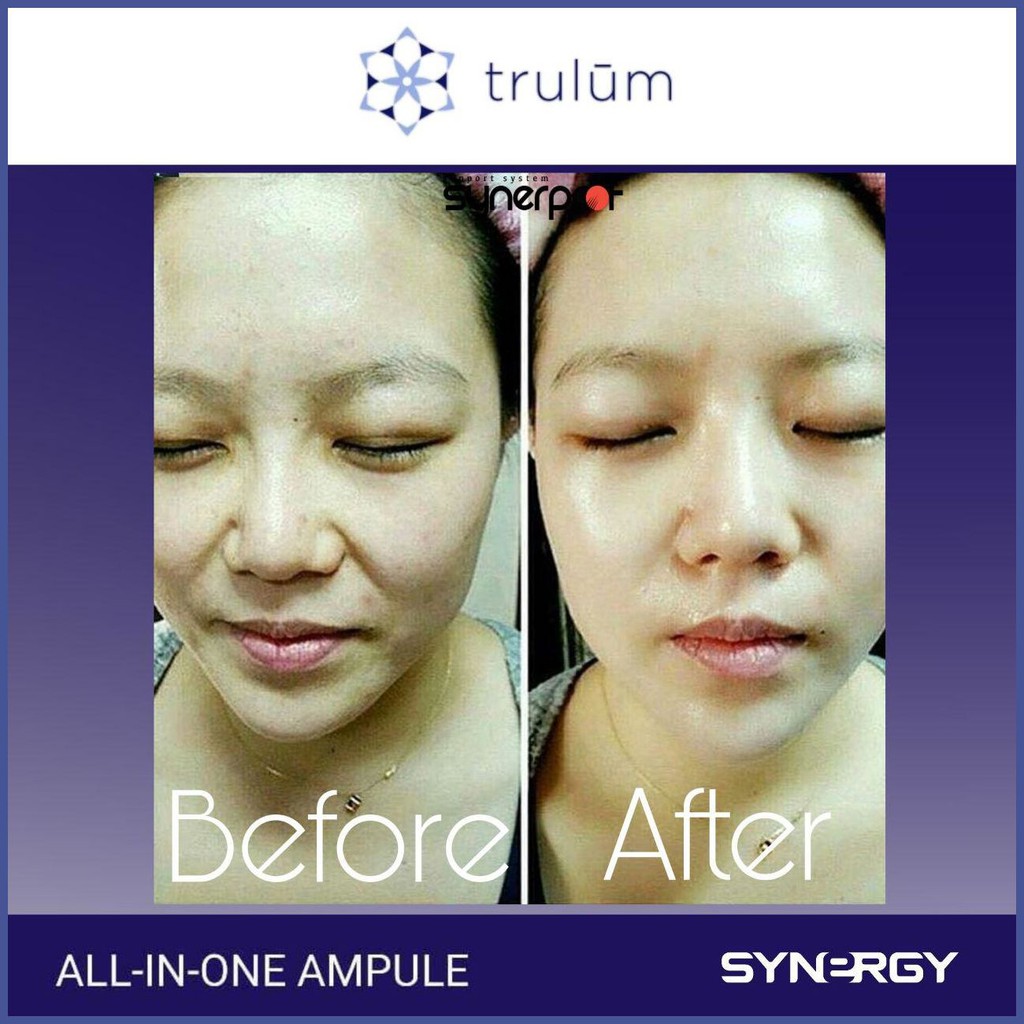 197 Serum Untuk Usia 14 Tahun Serum Untuk Menghilangkan Bekas Bopeng Cacar Di Wajah Trulum Shopee Indonesia