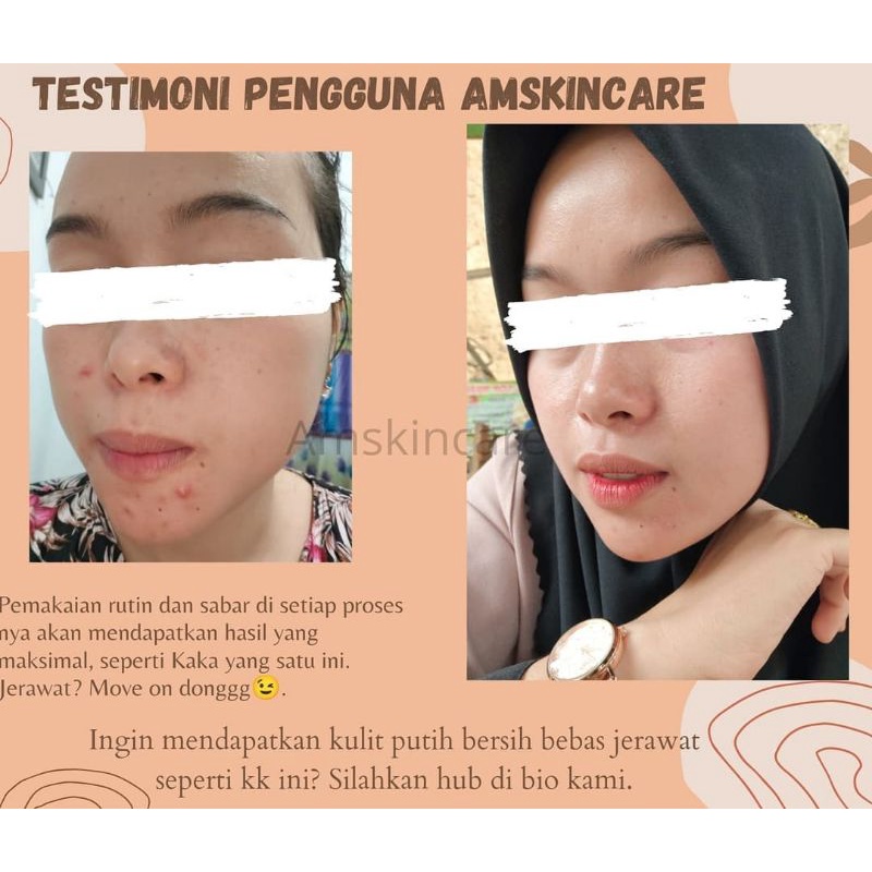 PAKET ACNE  BY AMSKINCARE | AMPUH USIR JERAWAT BANDEL