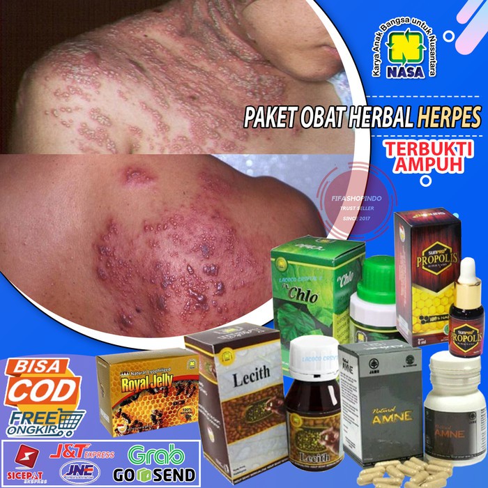 OBAT HERBAL HERPES NASA - OBAT CACAR AIR - OBAT CACAR ULAR TERUJI BPOM