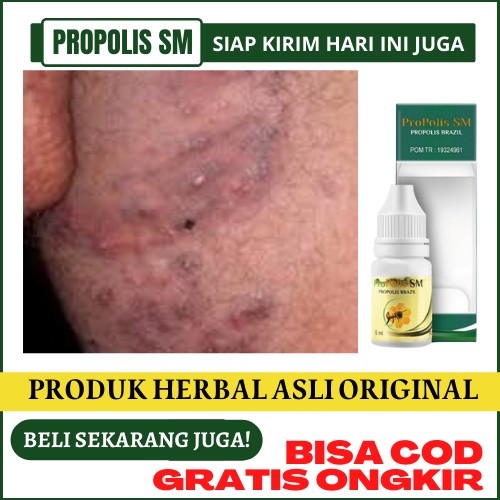 Obat Bokong Gatal Jamur Tak Kunjung Sembuh - Pantat Gatal Dan Timbul Ruam, Gatal Di Paha Dalam, Seki