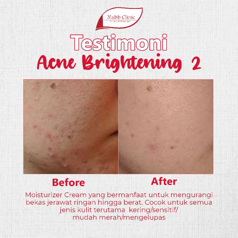 Acne Brightening(AB), Acne Minimized(AM),Anti Iritasi(AI), Acne 3, Acne 2