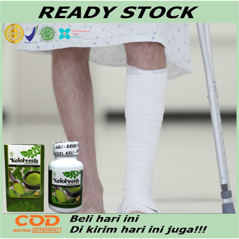 Obat patah tulang, Obat patah tulang dan retak, Obat patah tulang tangan, Obat patah tulang kaki, Ob