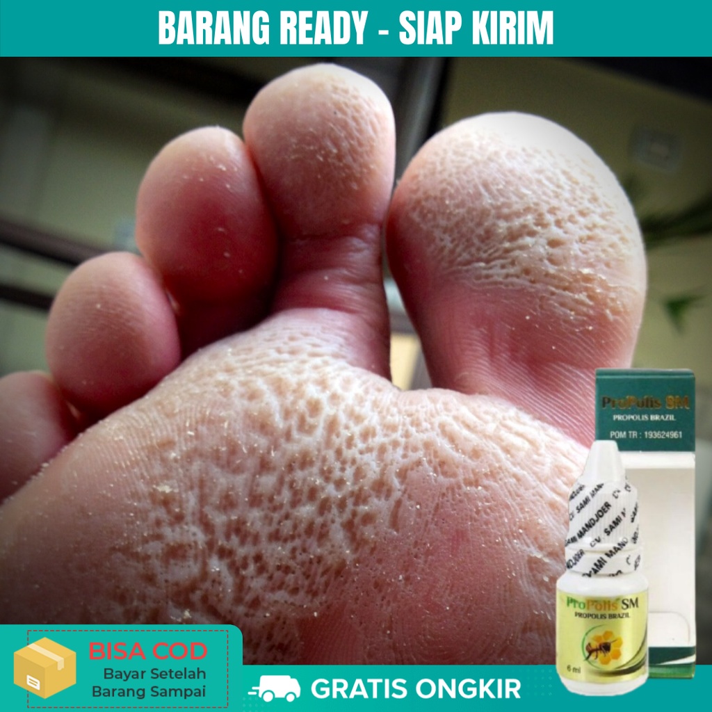 Propolis SM 6ml - Obat Kaki Rayapan, Telapak Kaki Berlubang Bolong Bolong Kecil Bau