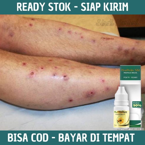 Jual Obat Darah Manis Bentol Prurigo Penyakit Kulit Kulit Gatal