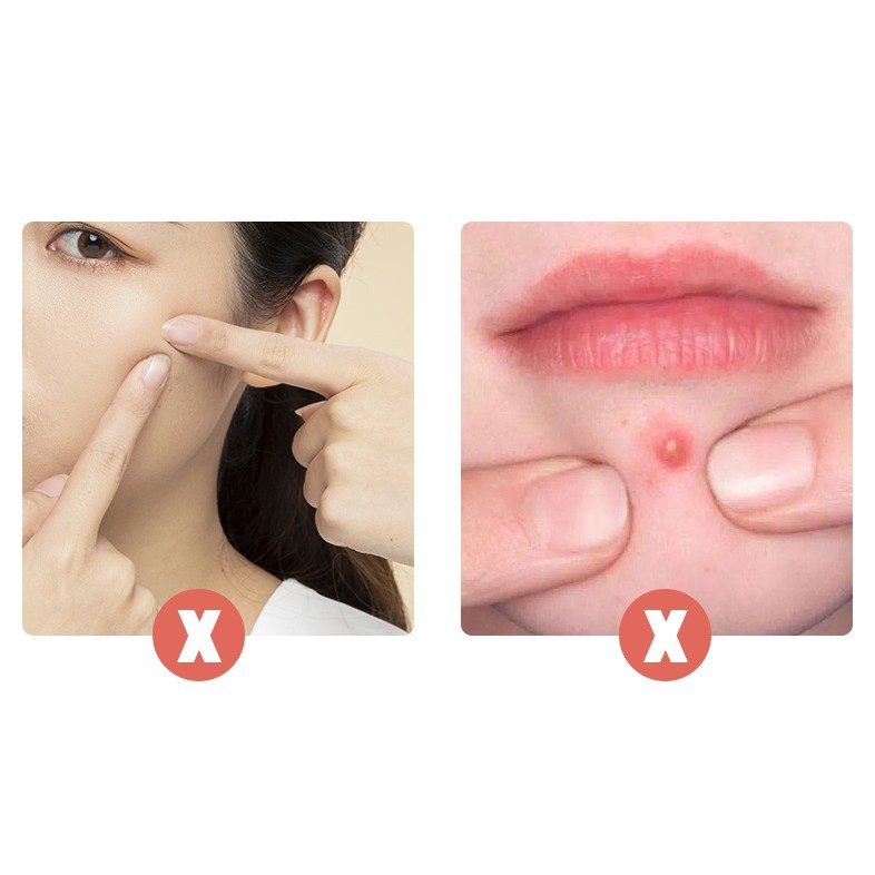 ELFYDO HL0140 Alat Pencet Jerawat Komedo Set 4 In 1 Pinset Jerawat Pembersih Blackhead