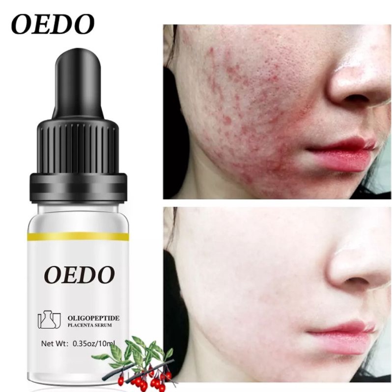 OEDO OLIGOPEPTIDE PLACENTA SERUM FACE CREAM ACNE TREATMENT SKIN CARE REPAIR WHITENING ANTI AGING WINKLES ESSENCE