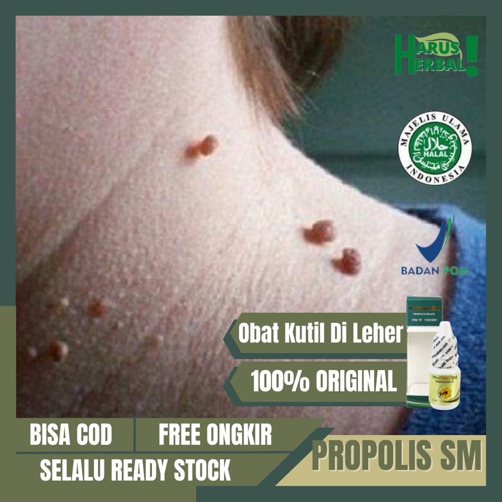 Obat Kutil Di Leher Alami, Obat Penghilang Kutil Papiloma, Obat Perontok Kutil Di Leher, Obat Penghi