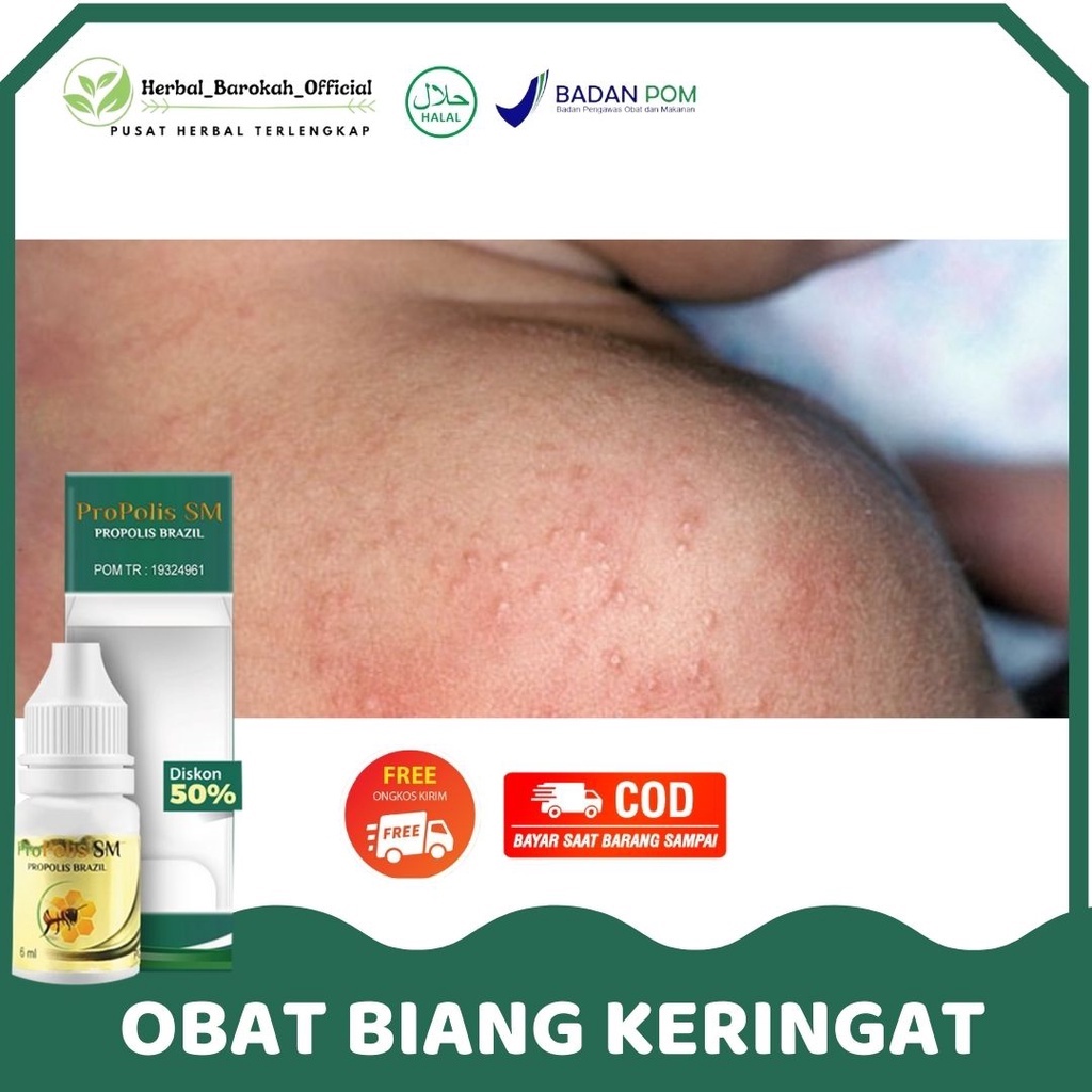 Jual Obat Oles Biang Keringat Ruam Merah Gatal Gatal Biang Keringat Di Wajah Leher Paha 9484