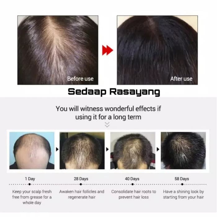 Lanbena Hair Growth Essential Oil Serum Penumbuh Rambut Anti Botak Ori
