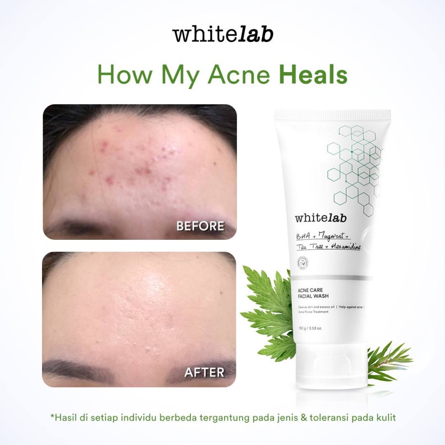 WHITELAB Acne Care Facial Wash | Sabun Muka Wajah Jerawat - 100gr