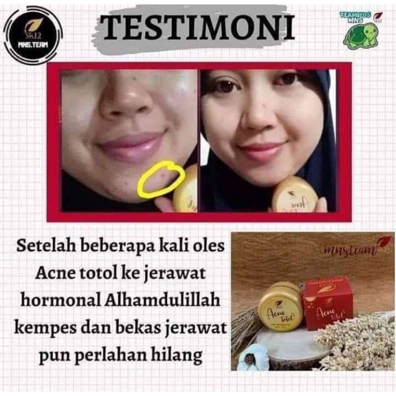 ACNE TOTOL SR12 HERBAL / CREAM OBAT JERAWAT AMPUH / JERAWAT KEMPES KERING / JERAWAT HORMONAL