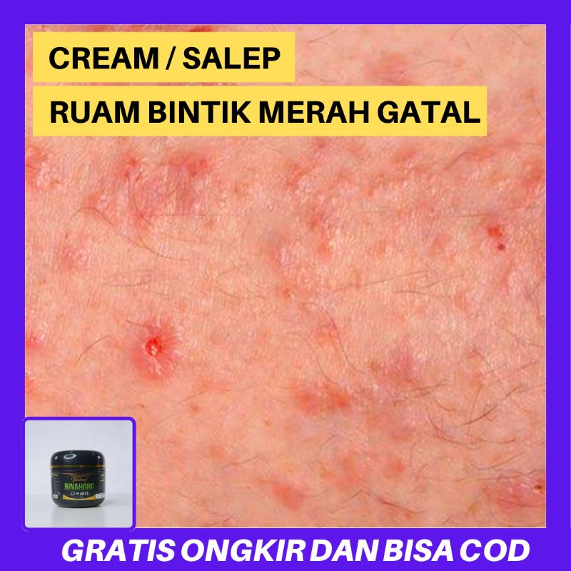 Cream Binahong Original Salep AntiGatal Seluruh Badan - Obat Gatal Gatal Kulit Menahun Paling Ampuh 