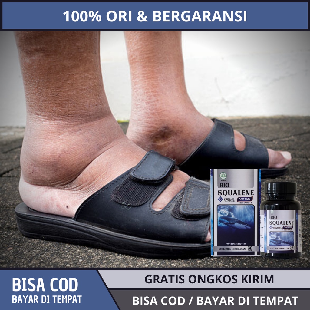 Jual Obat Kaki Bengkak Edema Penumpukan Cairan di Pergelangan Kaki