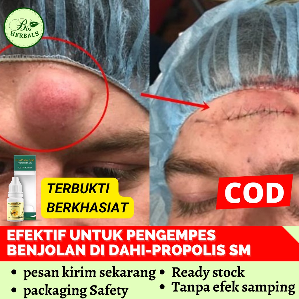 Propolis SM Pengempes Benjolan di Dahi Lipoma Tonjolan Lemak di Jidat Tumor Tiroid Kelenjar Getah Be