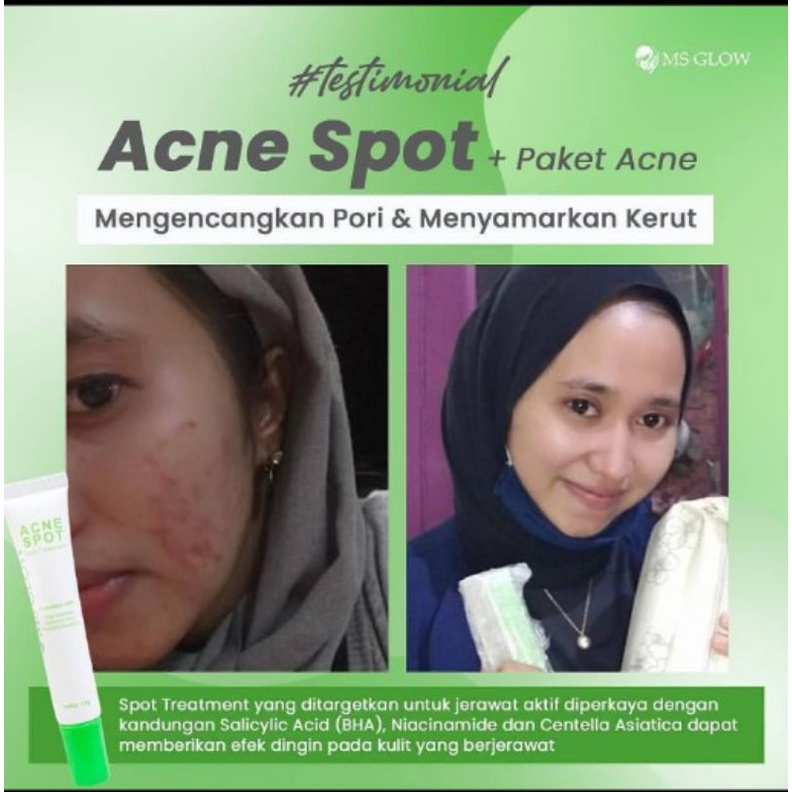 Acne Spot Treatment 15 gr II Khusus Jerawat batu/Radang MS GLOW