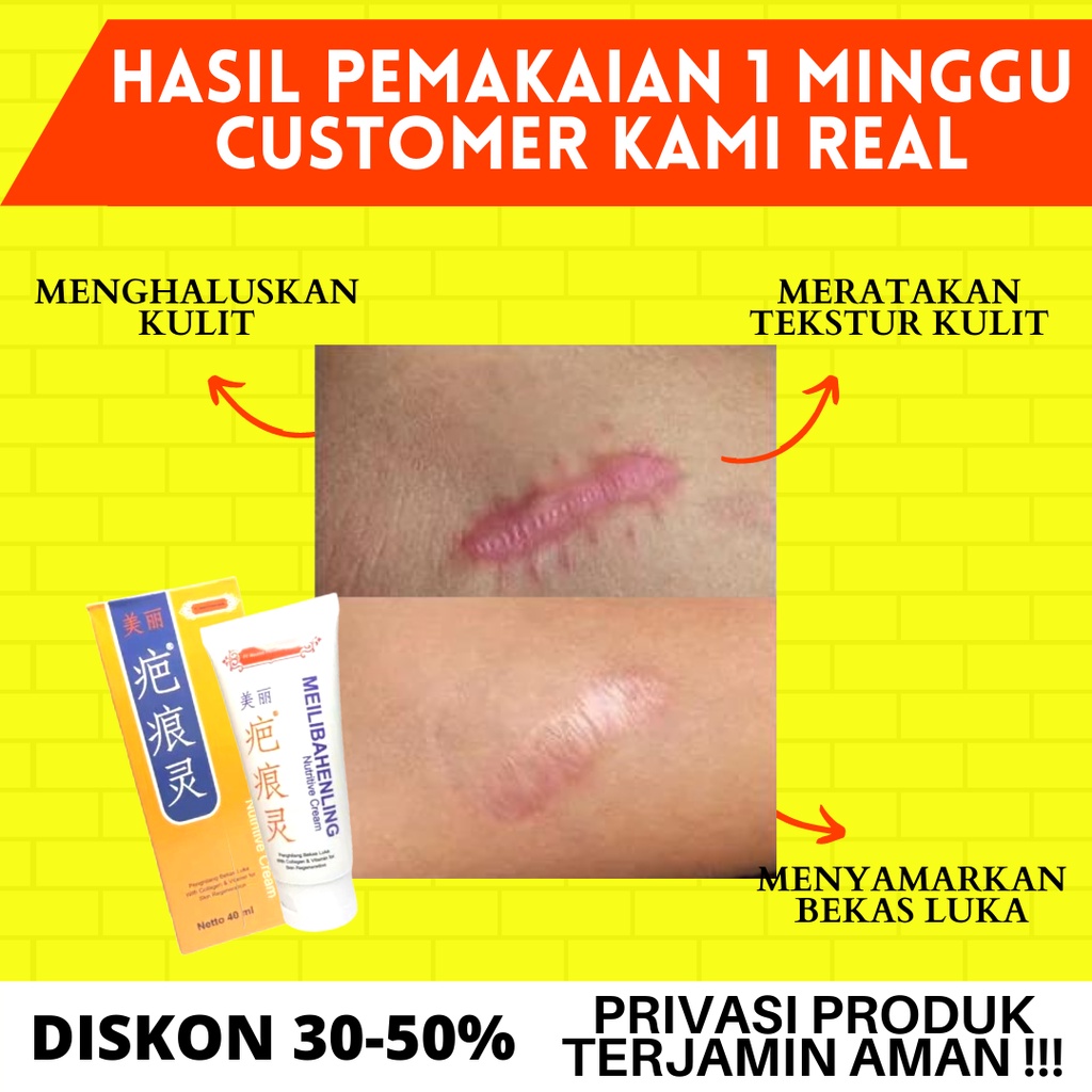 PENGHILANG BEKAS LUKA BAKAR SALEP GATAL  MEILIBAHENLING NUTRIVE CREAM 40ml PENGHILANG KELOID ORIGINAL BPOM