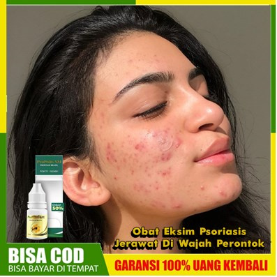 Obat Eksim Psoriasis Jerawat Di Wajah Perontok- Herbal Penghilang Ruam Jamur Kudis Kurap Beri-beri |