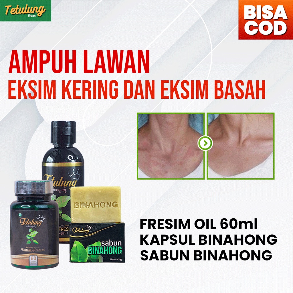 PAKET OBAT GATAL KULIT EKSIM AMPUH - 1 SABUN, 1 FRESIM OIL 60ML DAN 1 KAPSUL BINAHONG UNTUK SAKIT KULIT [SUDAH BPOM]