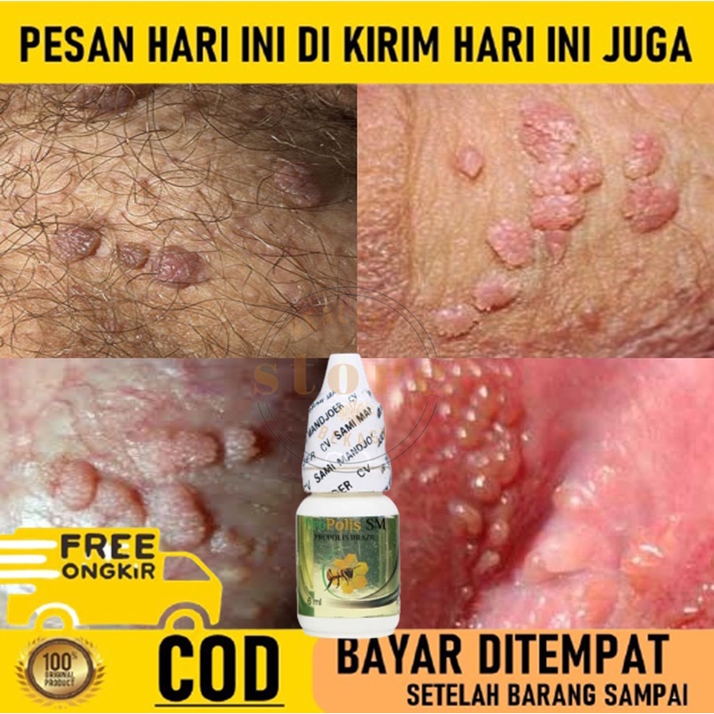 herpes zoster papiloma)