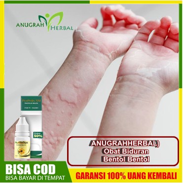 ANUGRAHHERBAL) Obat Biduran, Bentol Bentol, Gatel, Kaligata, Alergi Dingin, Penghilang Kulit Gatal