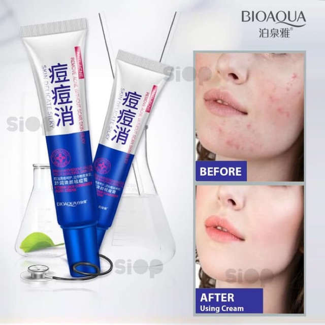 BIOAQUA Anti Acne-Oil control Acne Scar Remove Beauty Cream.