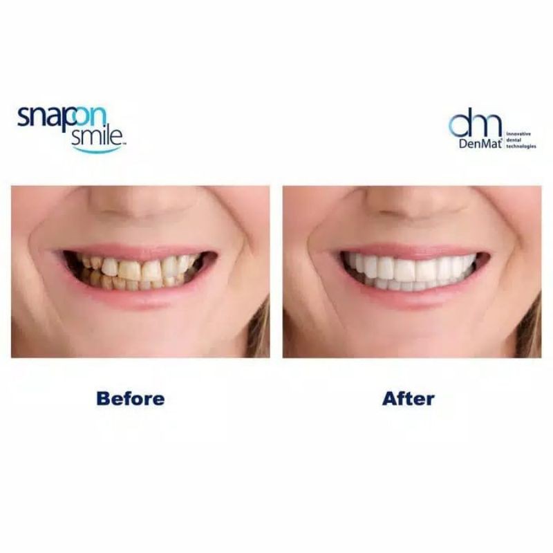 Laristerus79 Snap on smile veneers gigi palsu original TANPA  DUS