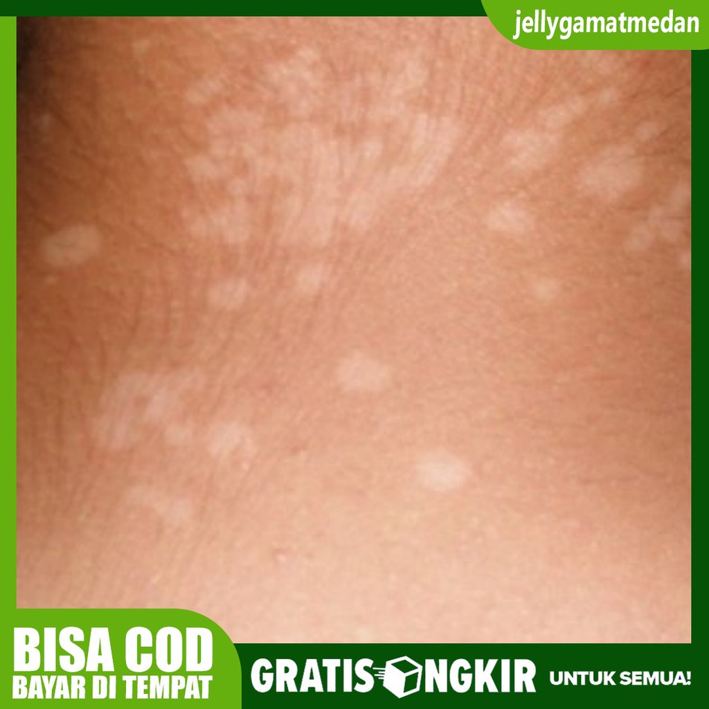 Obat Panu Kudis Kadas Kurap herpes Eksim - Obat Panu Wajah Selangkangan- Panu Minum - PROPOLIS SM