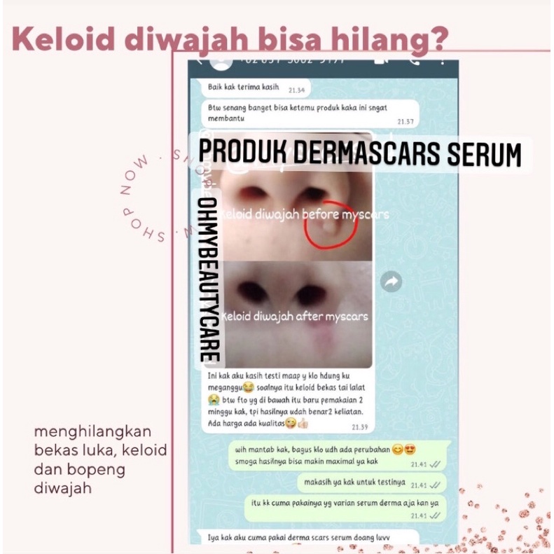 DERMASCARS SERUM | MEMBANTU MENYAMARKAN BEKAS LUKA DAN KELOID | SERUM DARKSPOT | SCAR HIPERTROPHIC |