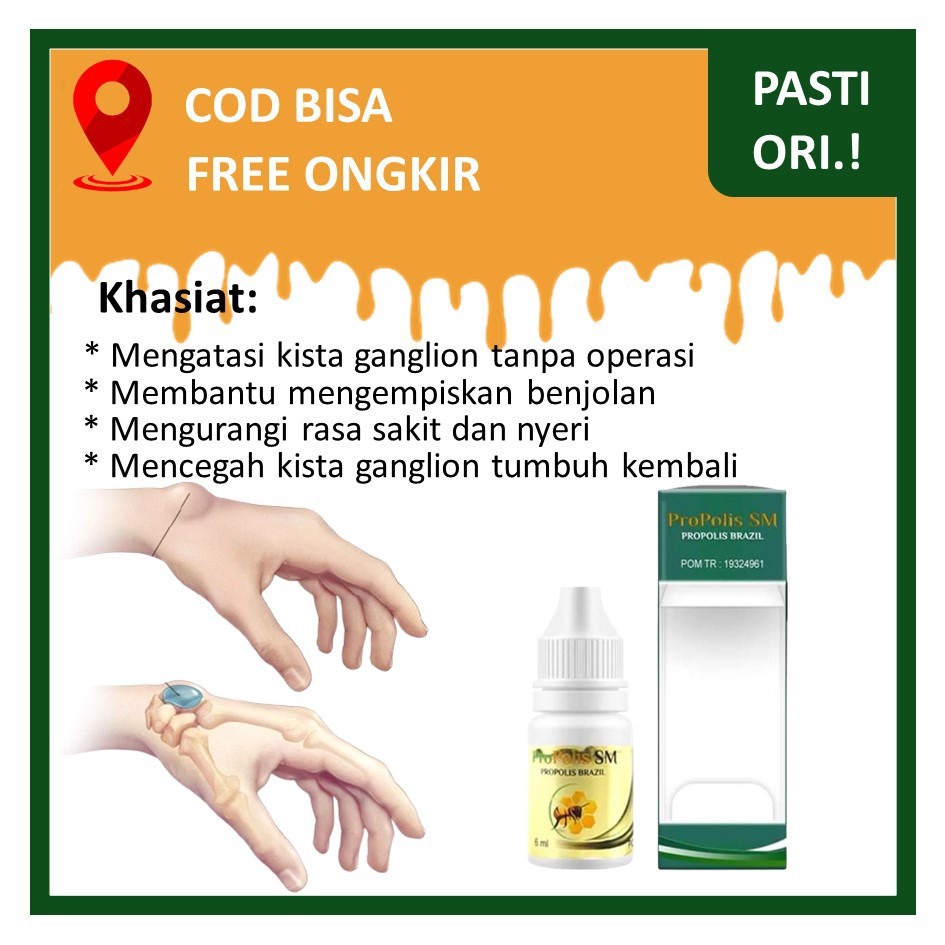 Obat Oles Kista Ganglion Di Tangan Atau Pergelangan Tangan Sendi Tangan