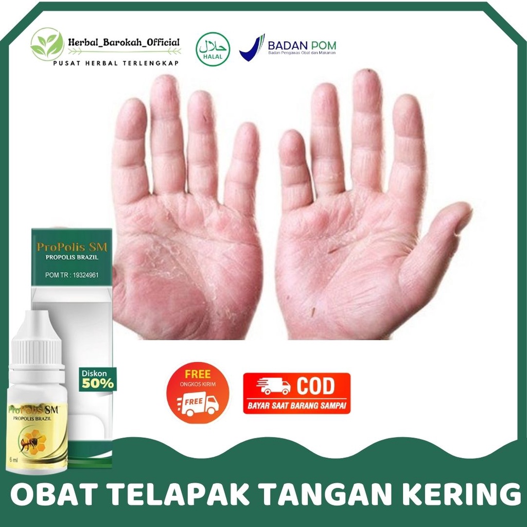 Obat Telapak Tangan Kering , Kering Dan Gatal , Kulit Mengelupas , Kulit Telapak Kaki Kering , Kulit