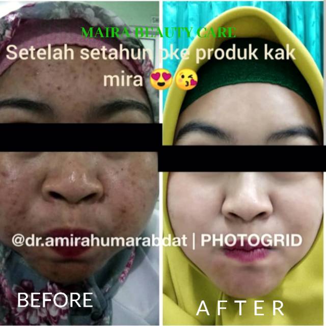 ACNE BRIGHT DOUBLE ACTION SERIES-6
