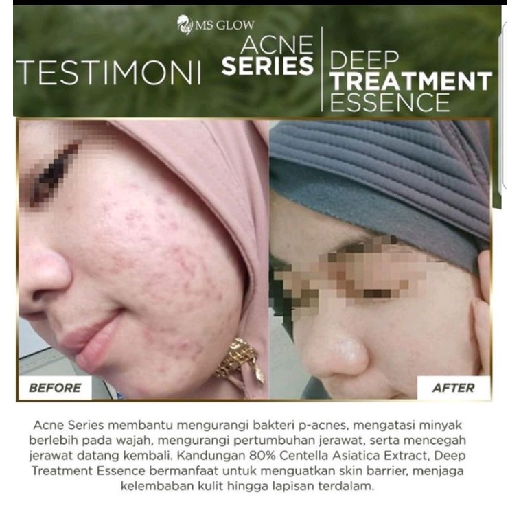 Paket Acne + Deep Treatment Essence Centela MS GLOW.