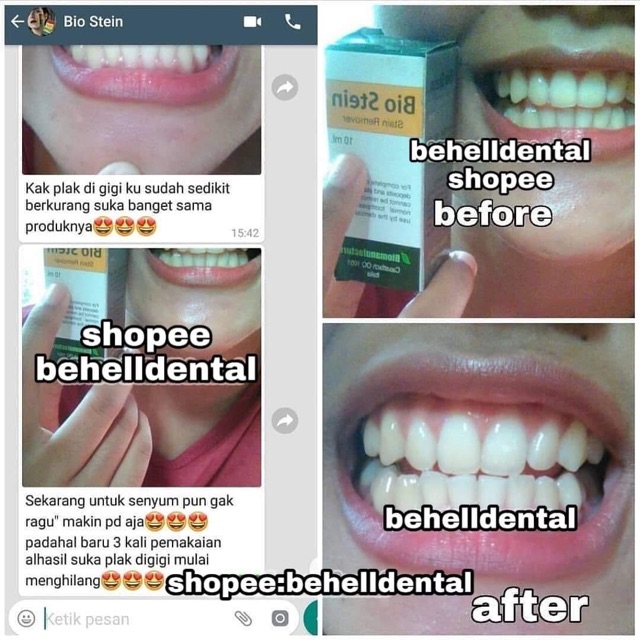 ORI | BIO STEIN WHITENING TEETH / PEMUTIH GIGI / BLEACHING TOOTH : Cairan Pembersih Noda Kuning Gigi Berbehel &amp; Tidak - Alat Bahan Penghilang Pembersih Plak Karang Gigi Ampuh / Pelunak Lem Behel Dan Veneer ORIGINAL / Mirip OCO Tsr