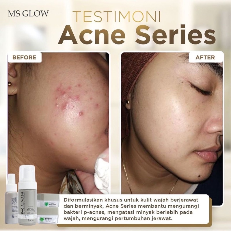 MS GLOW [𝐁𝐏𝐎𝐌] PAKET WHITENING ACNE ULTIMATE LUMINOUS ORIGINAL 100% Paket Wajah Lengkap Semua Series Msglow