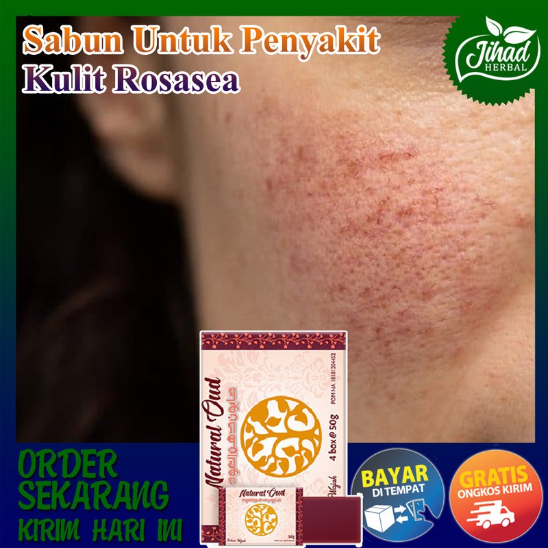 Jual Sabun Untuk Penyakit Kulit Rosasea / Rosacea di Wajah Atau Muka