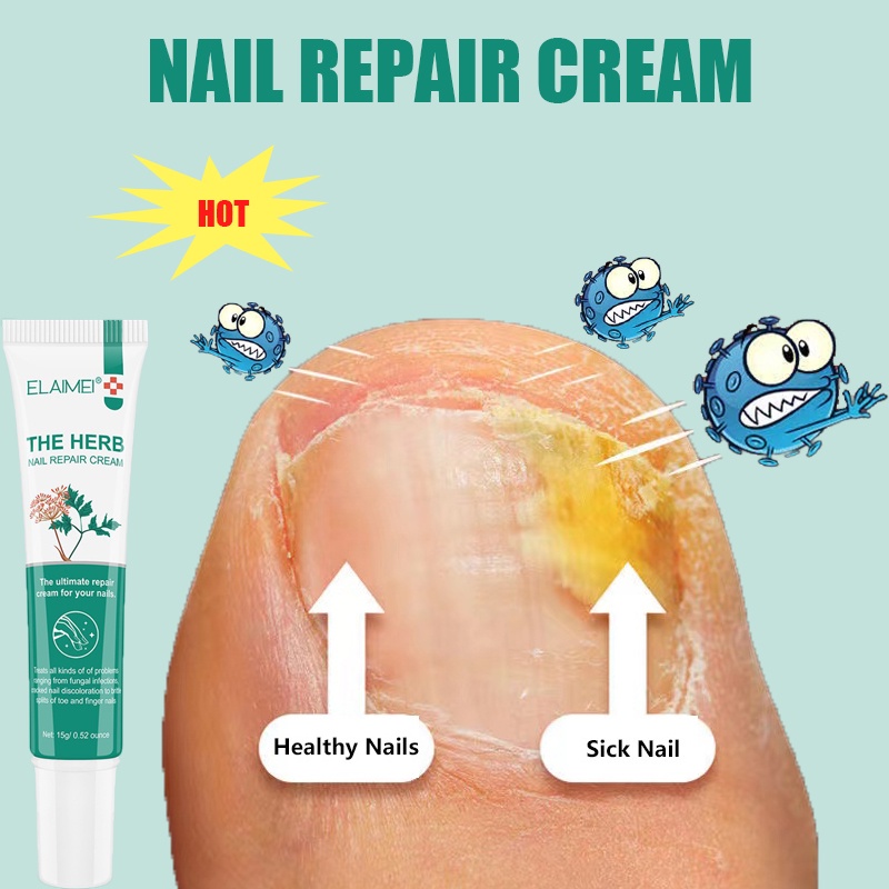 Perawatan kuku Krim Nail repair cream OnikomikosisParonychia Infeksi Kuku 15g  Anti Jamur Pengobatan Soften the cuticle Quick fix