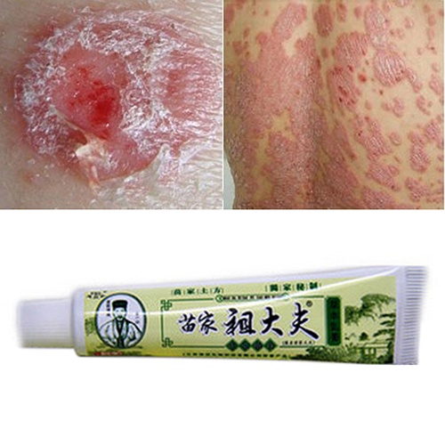 1Pc Chinese Herbal Psoriasis Eczema Psoriasis Cream Ointment