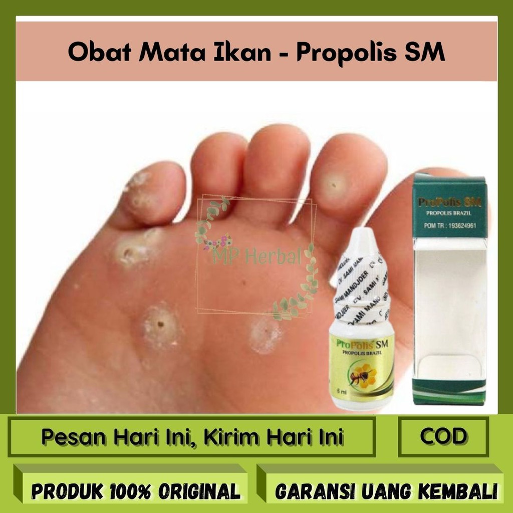 Jual Obat Mata Ikan Kaki Obat Mata Ikan Telapak Kaki Obat Mata Ikan Di Tangan Propolis Sm