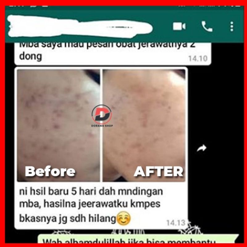 Obat Perawatan Wajah Jerawat Ampuh obat Jerawat Apotek Obat Jerawat Batu Obat Jerawat BPOM Jerawat Obat Jerawat Beruntusan Obat Jerawat Cewek Cowok Obat Jerawat Pria Obat Jerawat Herbal Obat jerawat Murah Obat Jerawat Murah Obat Jerawat Oles