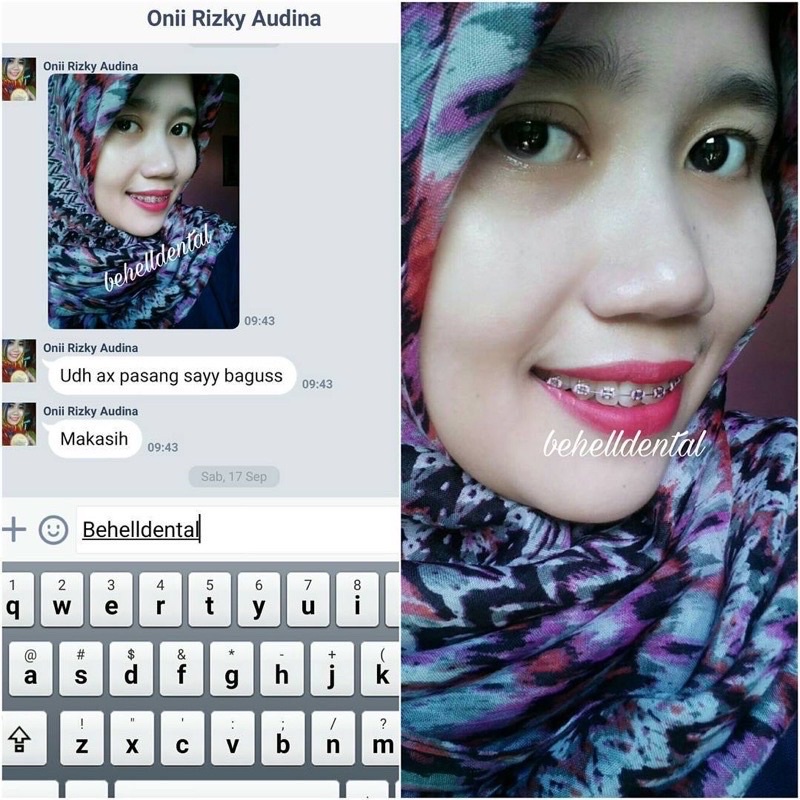 Behelldental - PAKET BEHEL PERMANEN PERBAIKIN GIGI TIPE BRACKET FDA MIM ROTH HIGH QUALITY - Kawat Dental Geousis Luxury With Hook 0.22 Perawatan Gigi Mini Metal Ortho Braket Braces Original