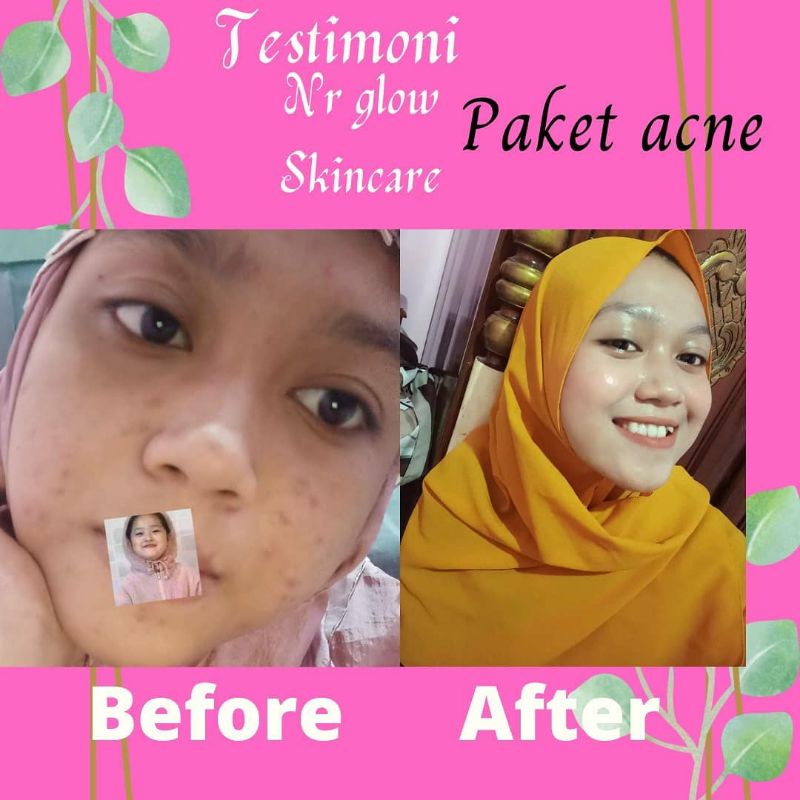 CREAM WAJAH BERJERAWAT BRUNTUSAN MILEA - NR GLOW ACNE BPOM - SERUM JERAWAT AMPUH