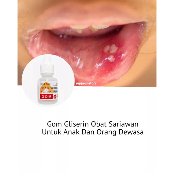 Gom Gliserin Obat Sariawan Untuk Anak Dan Orang Dewasa Ampuh