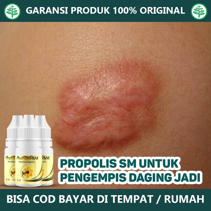 Jual Obat Pengempis Daging Jadi, Keloid, Perontok Papiloma, Kutil Alami