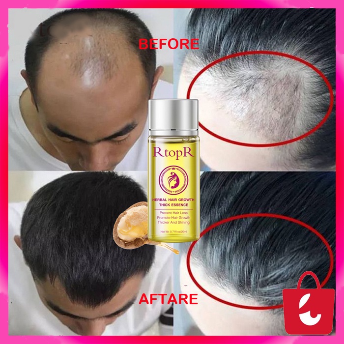 [100% Asli + Ampuh] RtopR Minyak Rambut Anti Rontok Botak Perawatan Pertumbuhan Rambut Cepat Tebal 20ml