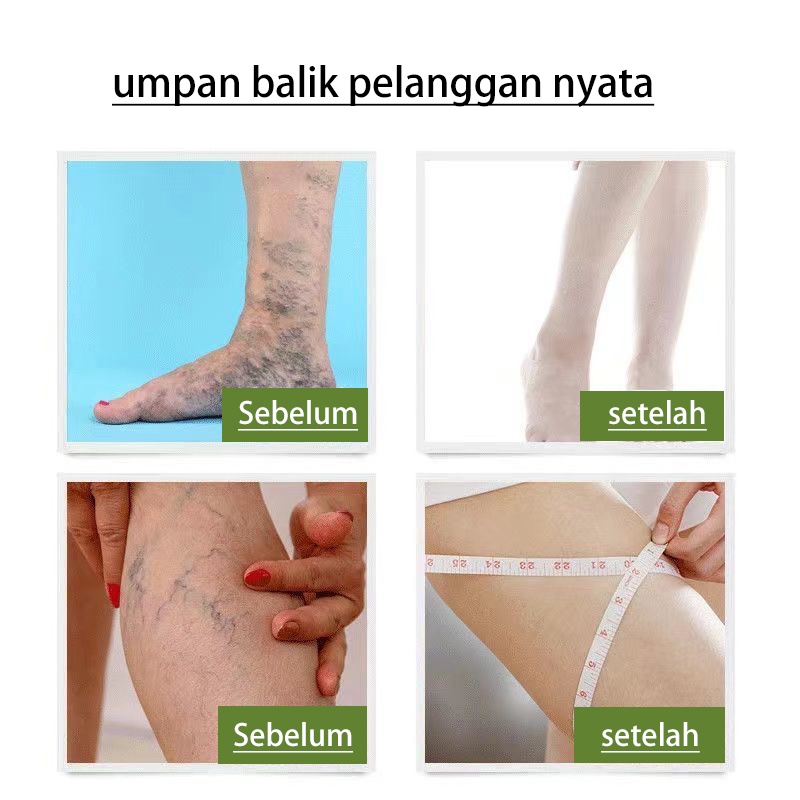 obat varises 50g Varises Obat Varises Paling Ampuh Pijat kaki untuk menghilangkan rasa sakit / mengeruk meridian / perawatan relaksasi vena dan krim perbaikan Bengkak Benjolan Vaskulitis Flebitis Pengobatan Vaskulitis