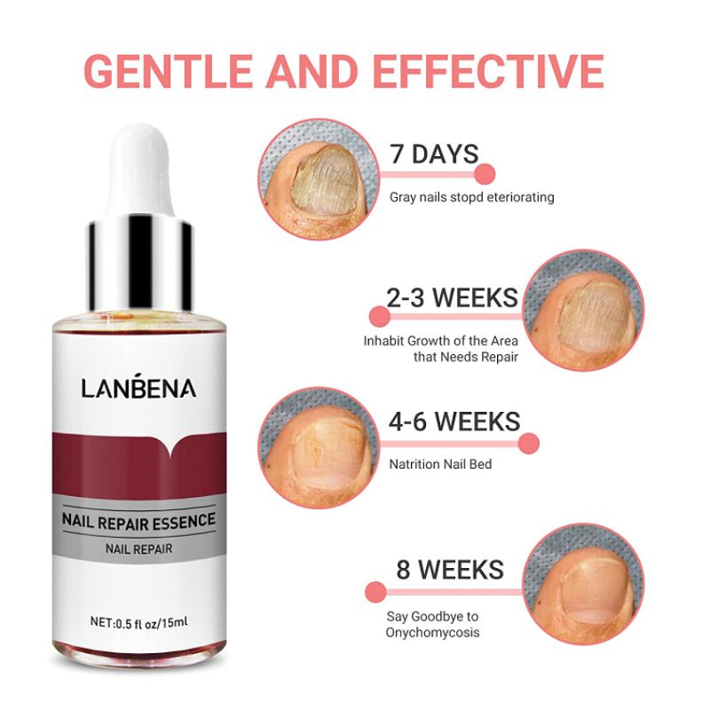 Lanbena Nail Repair Essence [Gratis Alat Kikir Kuku] / Lanbena Perawatan Kuku Kaki &amp; Tangan / Lanbena Serum Perawatan Kuku / Lanbena Oil Serum Nail Treatment / Lanbena Perawatan Kuku Esensi Serum Jamur Kuku / Serum Perawatan Jamur Kuku Pecah Kasar