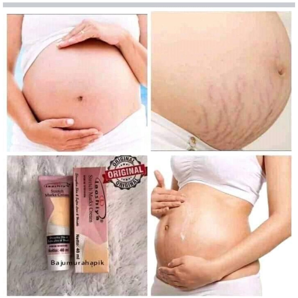 Penghilang Strechmark Cream Penghilang Bekas Luka Penghilang Keloid Penghilang Selulit Ampuh Salep